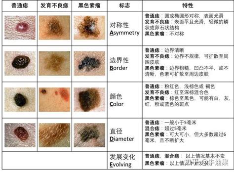 背部很多痣|我的痣会变成黑色素瘤吗？大量图例看完就懂